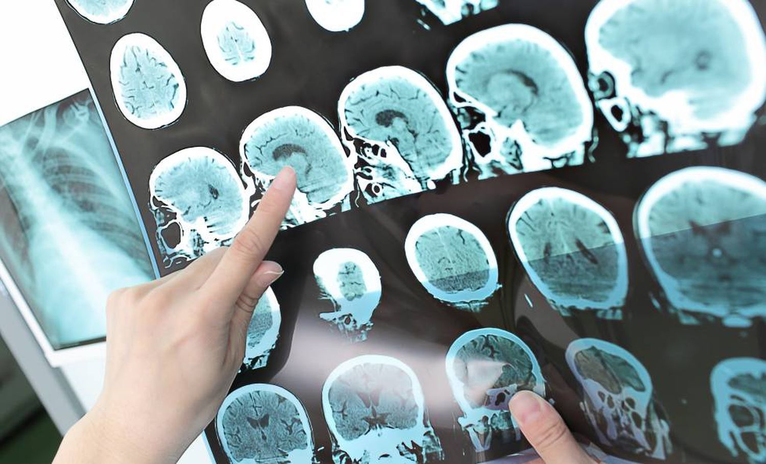 Cérebro de um paciente com Alzheimer Tomografia e Ressonância podem auxiliar no diagnóstico do Alzheimer